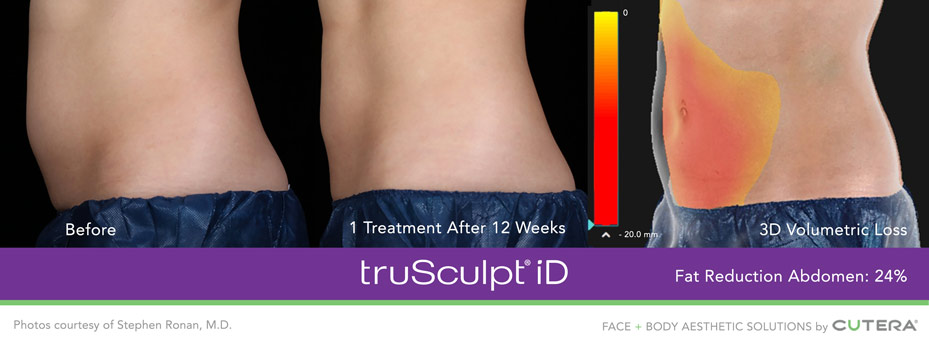 before and after body contouring in Tysons Corner, VA