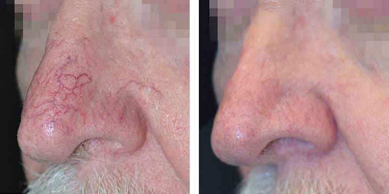 Facial Veins Fairfax