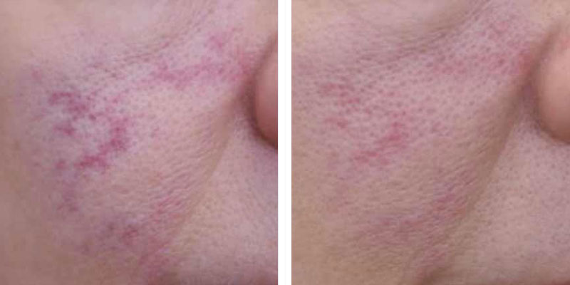 Facial Veins Tysons Corner