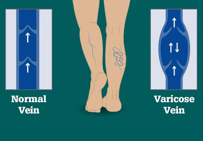 Laser Vein Treatment Fairfax