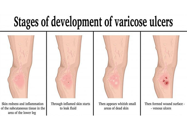 Leg Ulcer Treatment Fairfax