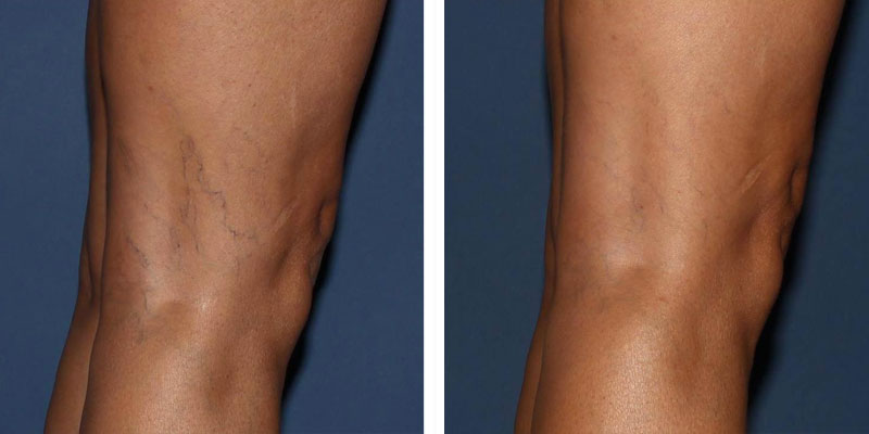 before and after images of legs after treating spider veins in Fairfax and Tysons Corner, VA