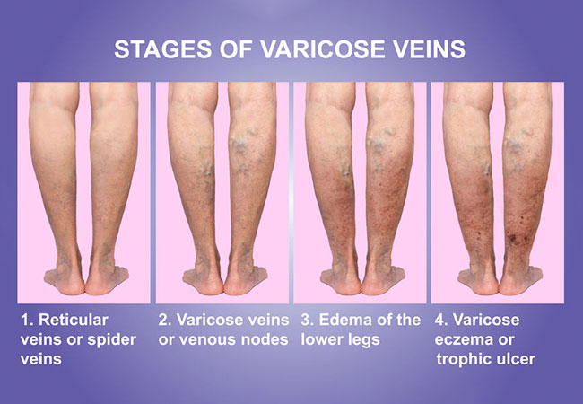 Leg Vein Treatment Fairfax