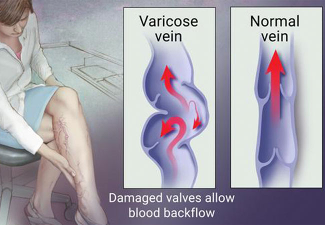 illustration of normal veins to varicose veins Fairfax, Va
