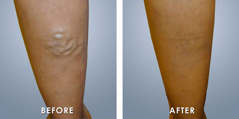 before and after varicose vein treatment Fairfax