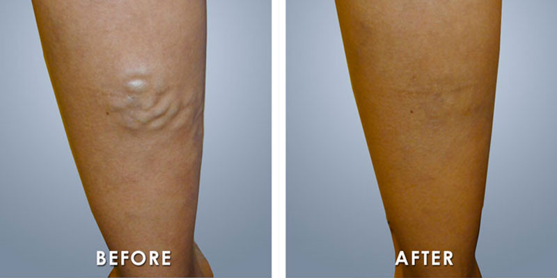before and after varicose vein treatment in Fairfax and Tysons Corner, VA