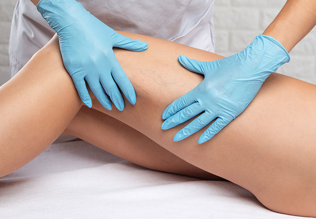 patient getting leg treatment for varicose veins in Fairfax and Tysons Corner, VA