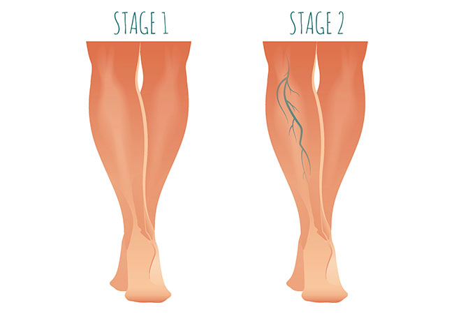illustration of varicose veins stages 1 and 2 before leg vein treatment in Fairfax and Tysons Corner, VA